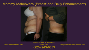 Mommy Makeover Video Presentation with Breast Augmentation and Tummy Tuck before and after pictures