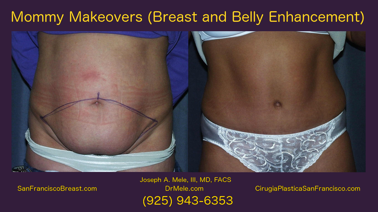 Mommy Makeover Video Presentation with Breast Augmentation and Tummy Tuck before and after pictures