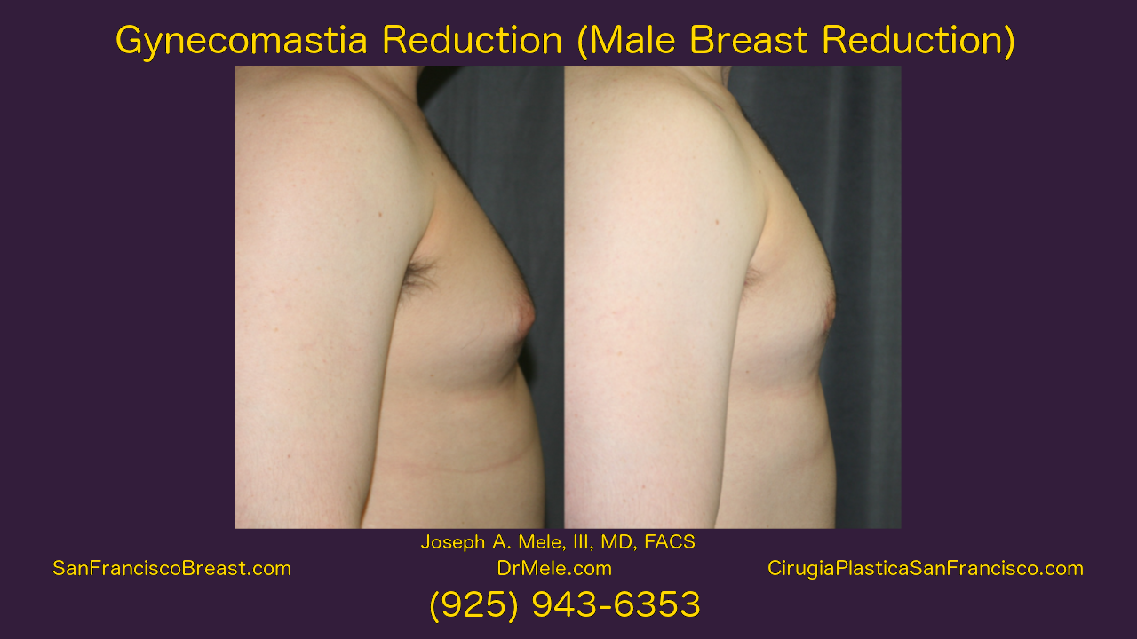 Gynecomastia Reduction Before and After Pictures Video (Male Breast Reduction)