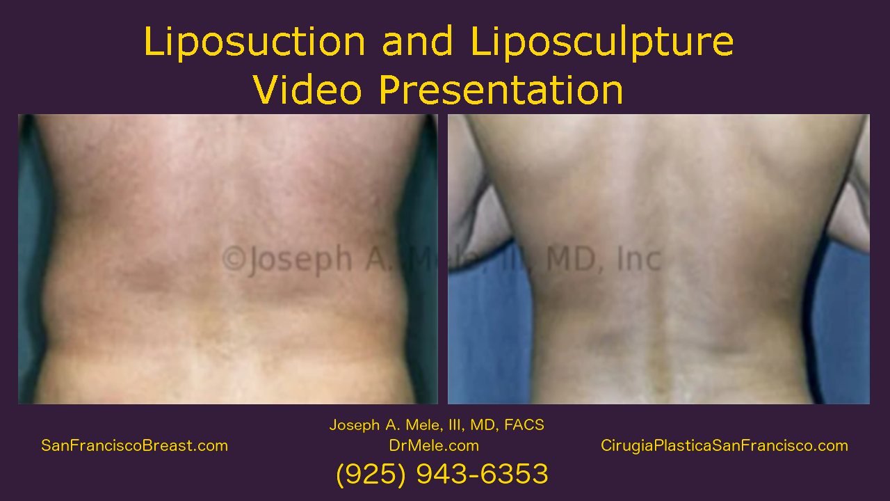 Liposuction Video Liposculpture Before and After Pictures