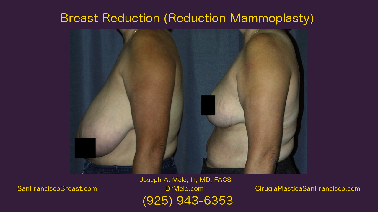 Breast Reduction Video Presentation with reduction mammoplasty before and after pictures