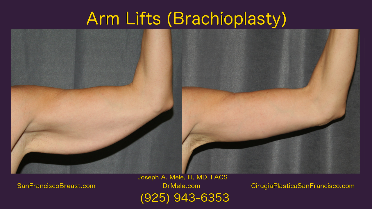 Arm Lift Video Presentation with Brachioplasty Before and After Pictures