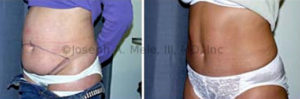 Tummy Tuck - Before and After shows fat removal plus tightening of skin and muscle of the abdominal wall.