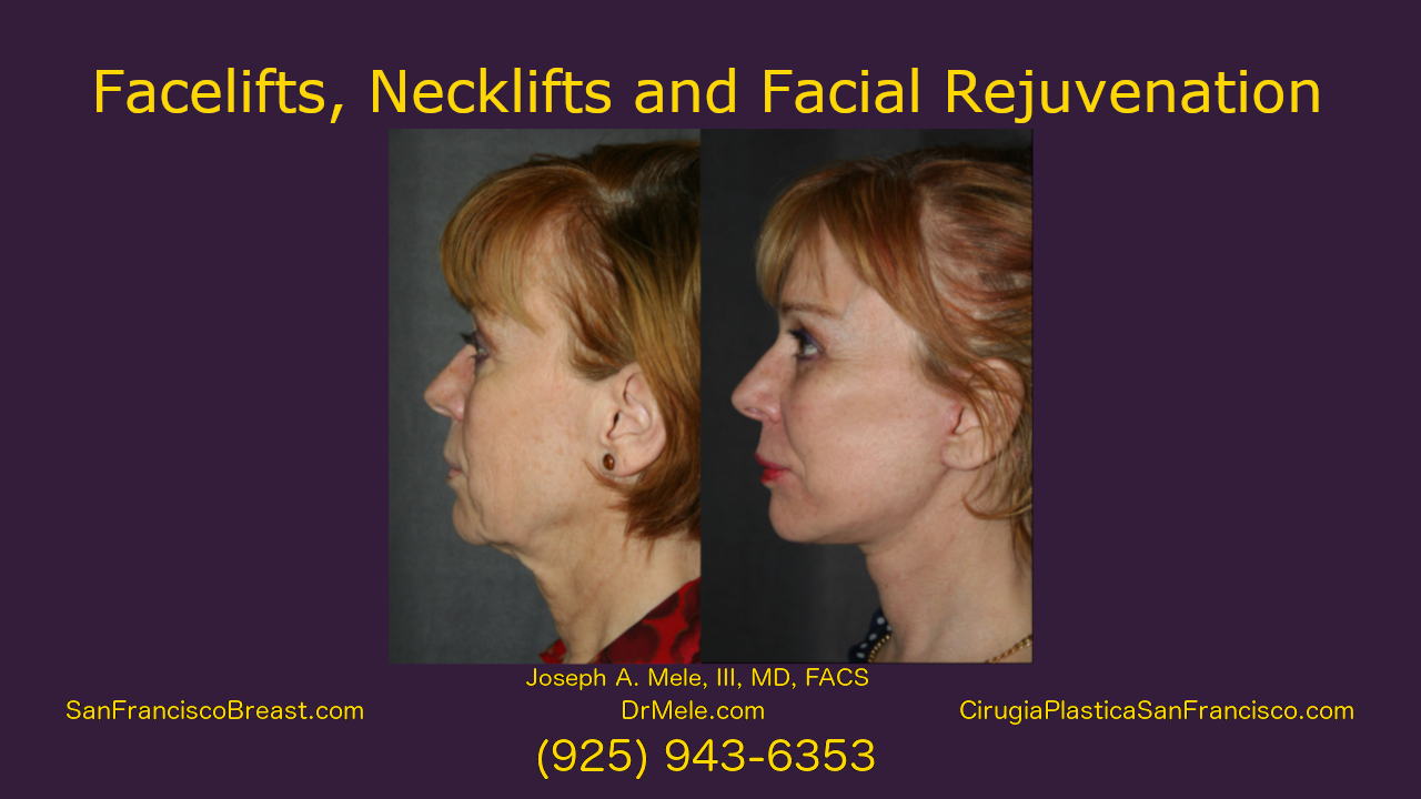 facelift, neck lift facial rejuvenation video with rhytidectomy before and after pictures