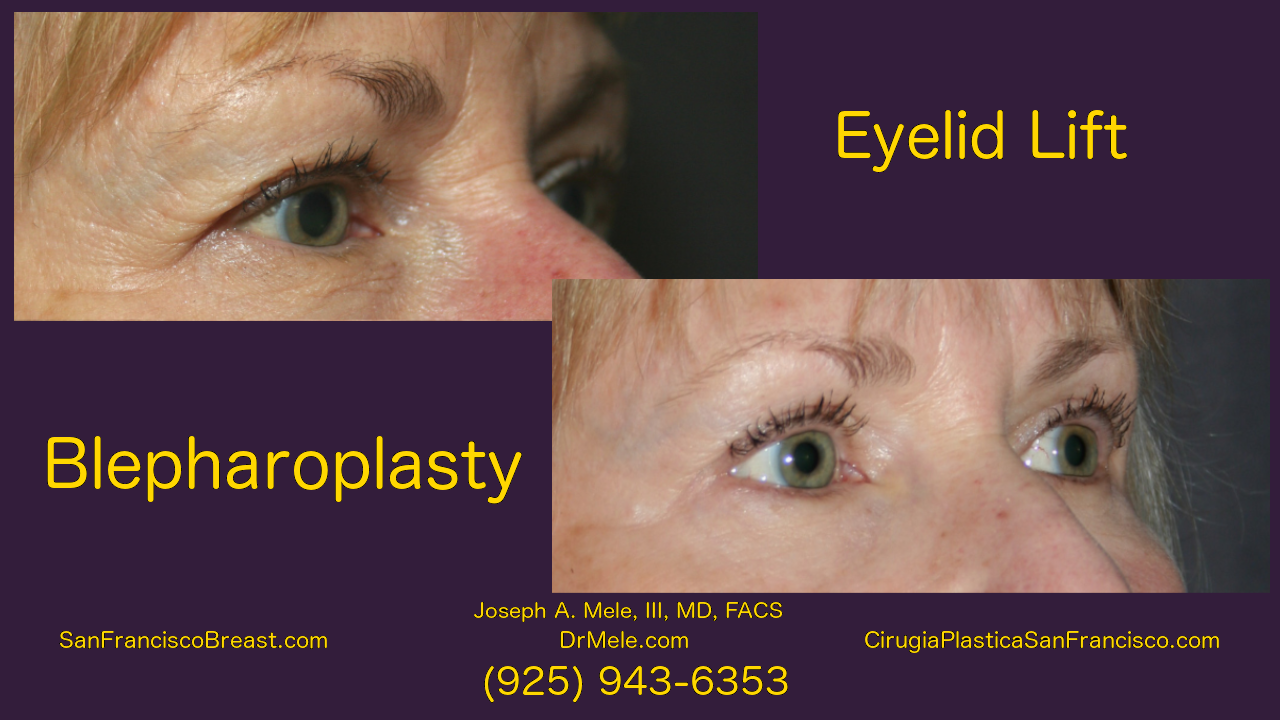 Blepharoplasty Video with before and after pictures and Asian double eyelid surgery