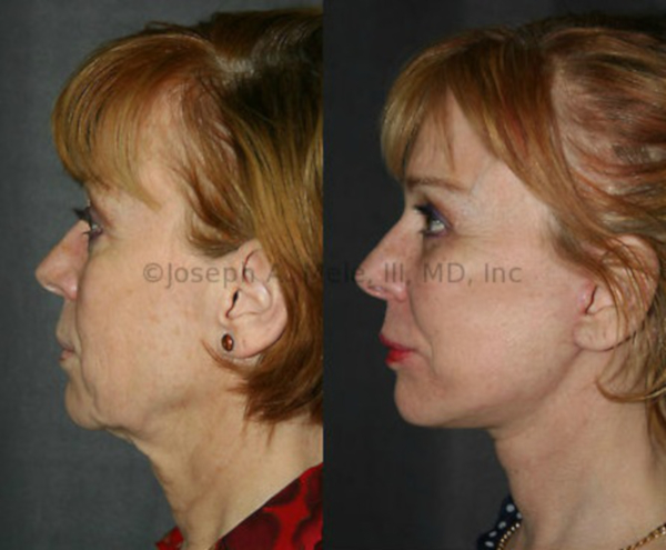 Facelift with Cheek Augmentation