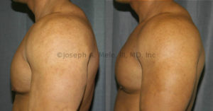 Gynecomastia Reduction: This man is in great shape, and works hard at it. A small amount of Gynecomastia over the lower pole of the breast was hiding his true physique.
