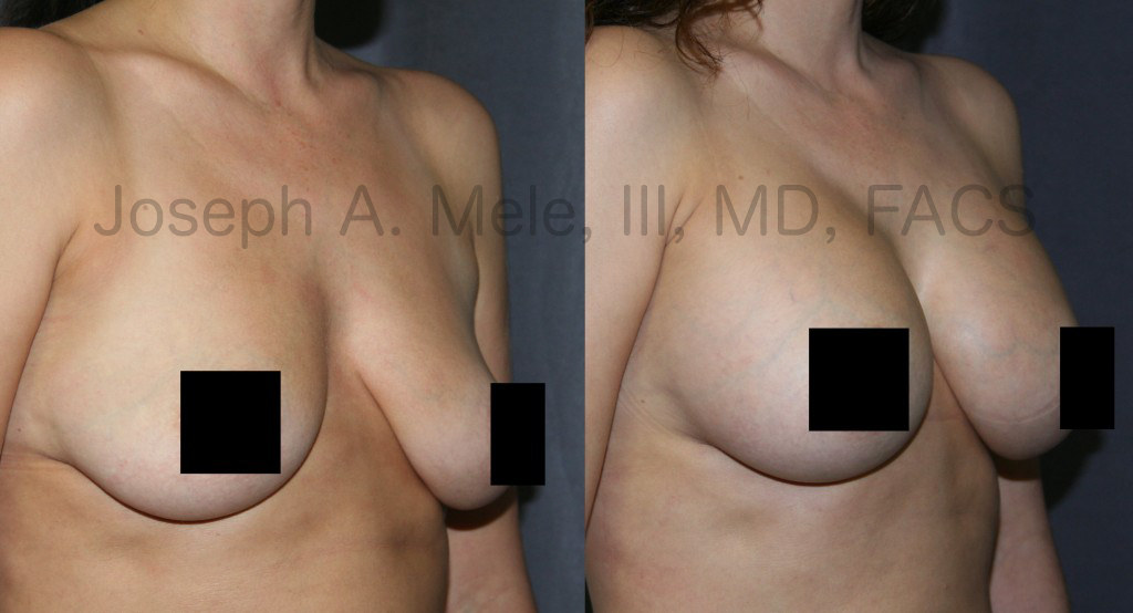 Breast Augmentation remains the most popular Cosmetic Plastic Surgery procedure. 