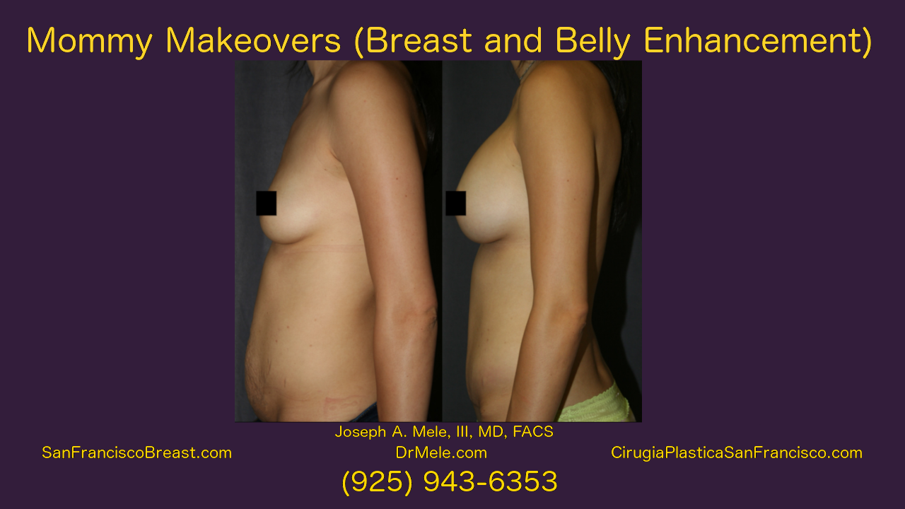 Mommy Makeover Video Presentation with Breast Augmentation and Tummy Tuck before and after pictures