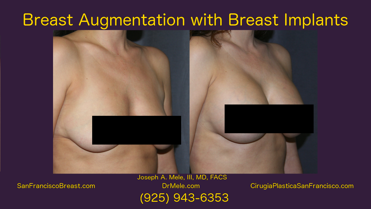 Breast Augmentation Video Presentation with breast implant before and after pictures