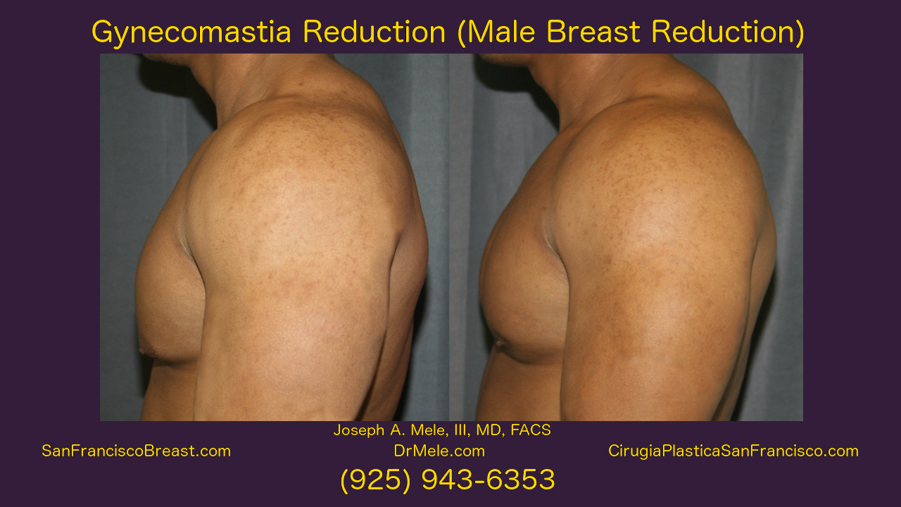 Gynecomastia Reduction Before and After Pictures Video (Male Breast Reduction)