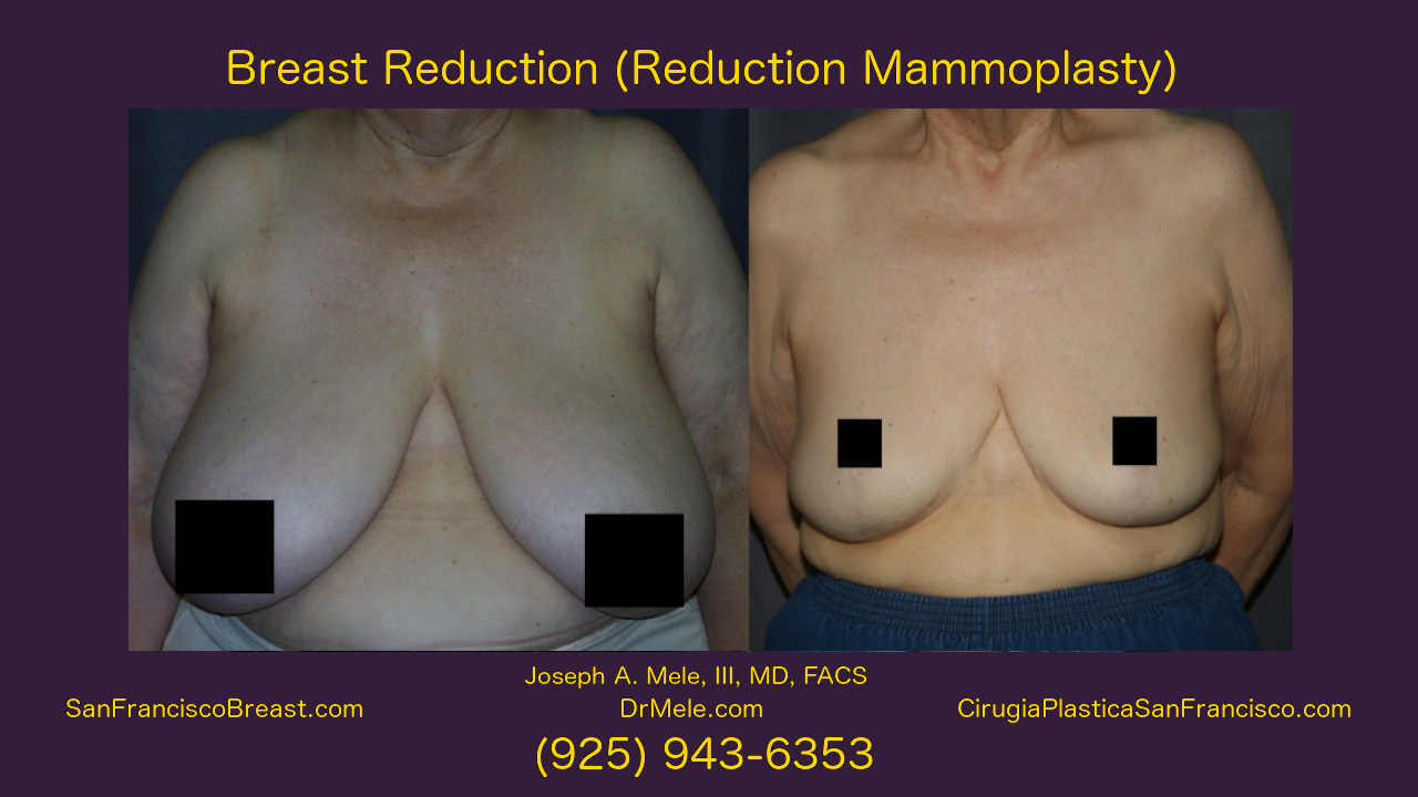 Breast Reduction Video Presentation with reduction mammoplasty before and after pictures