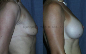 For every breast, The Best Breast Implant will vary. A Board Certified Plastic Surgeon can help you make the best possible choice.