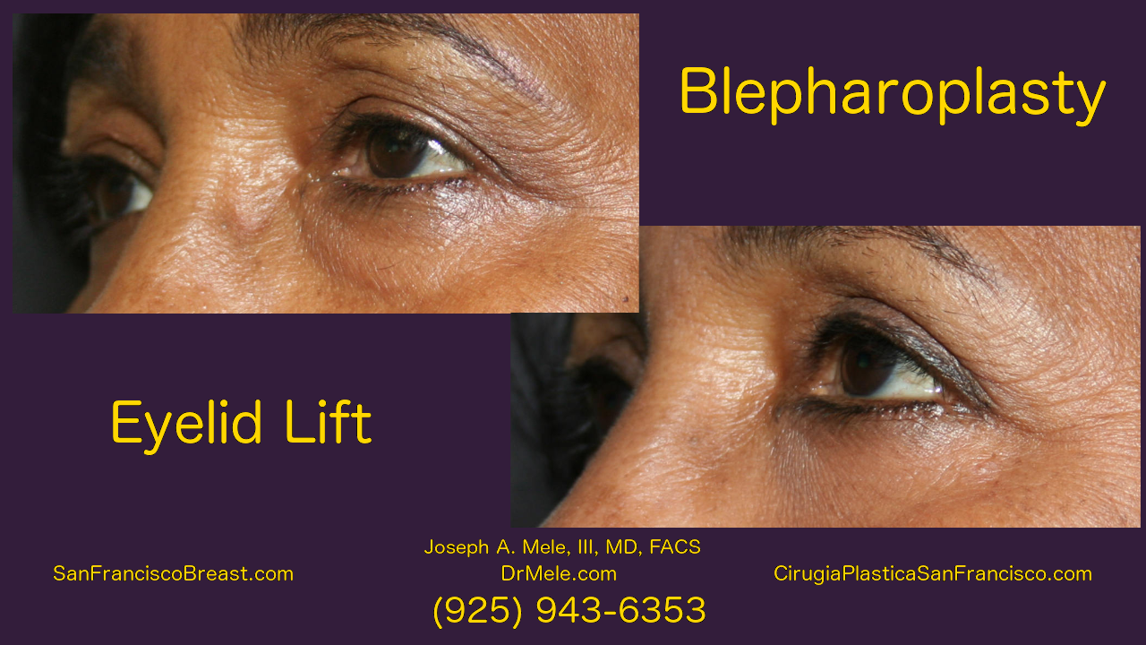 Blepharoplasty Video with before and after pictures and Asian double eyelid surgery