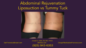 Abdominal Rejuvenation Video - Tummy TUck vs. Liposuction with before and after pictures