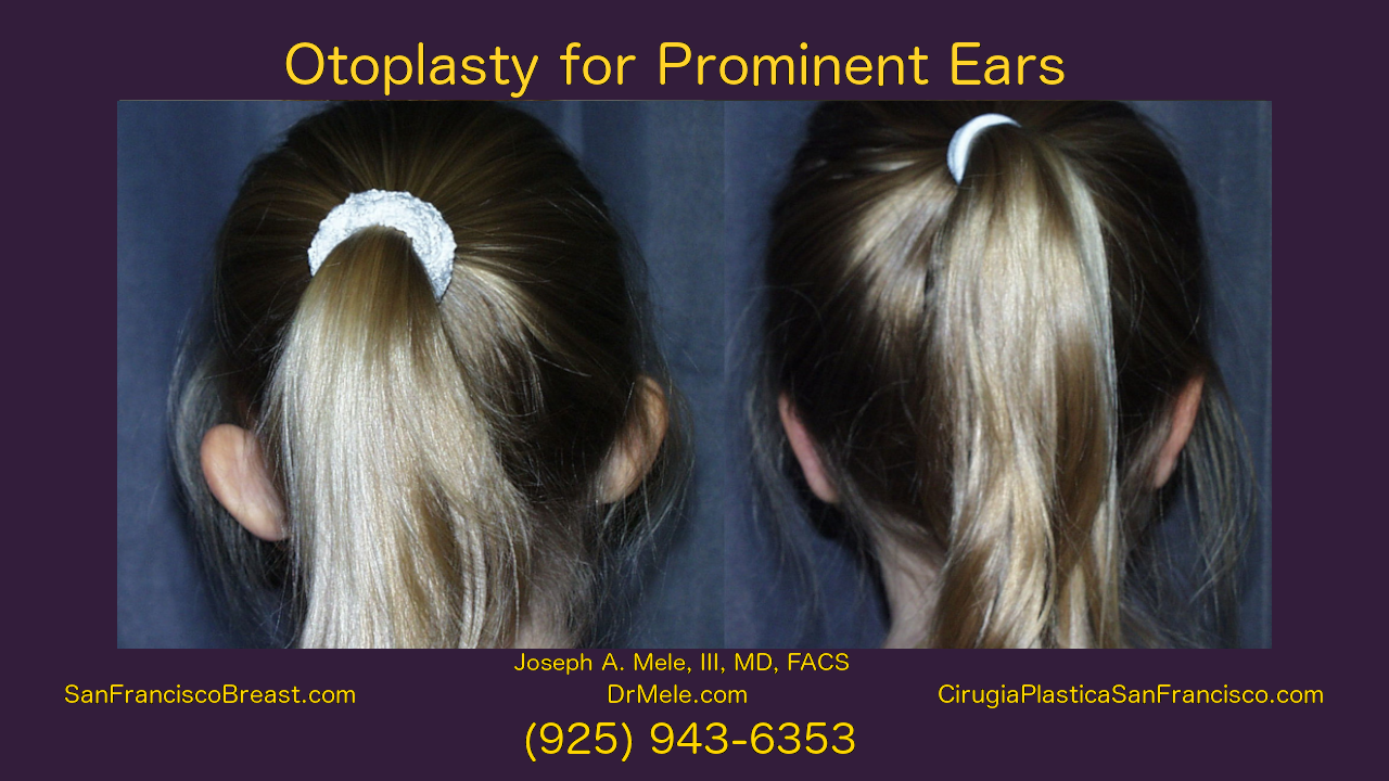 Otoplasty Video Presentation with ear pinning before and after pictures