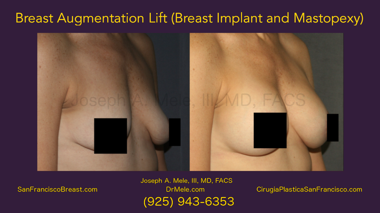 Breast Augmentation Lift Video (Breast Implant and Mastopexy) before and after pictures