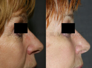 Cheek implant videos presentation with cheek augmentation before and after pictures.