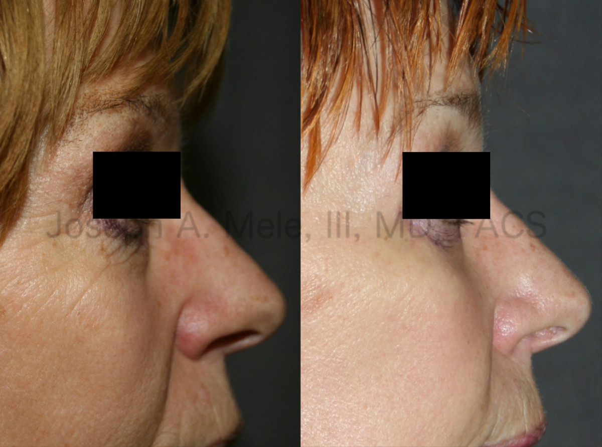 Cheek implant video presentations with cheek augmentation before and after pictures.