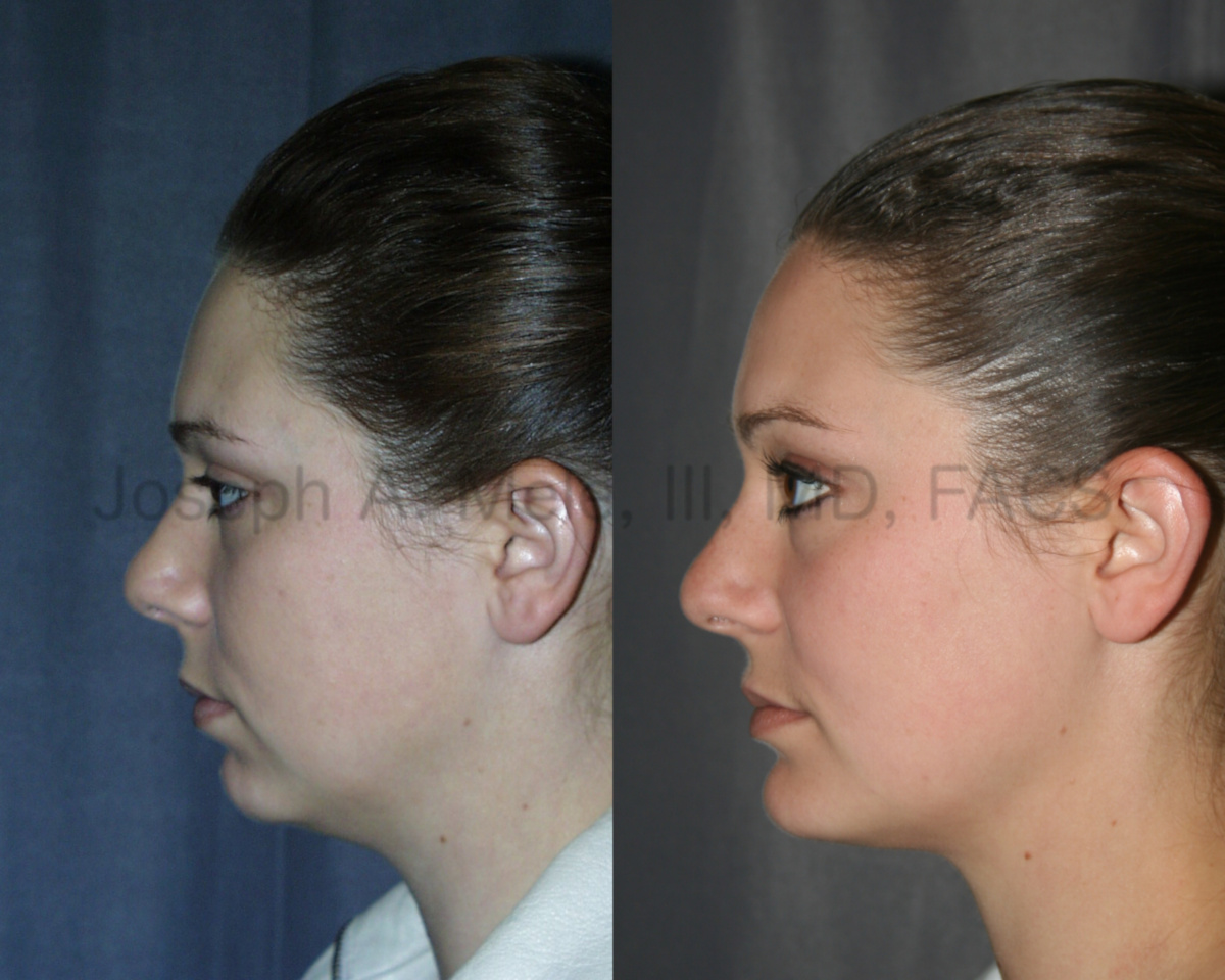 Chin implant videos presentation with chin augmentation before and after pictures.