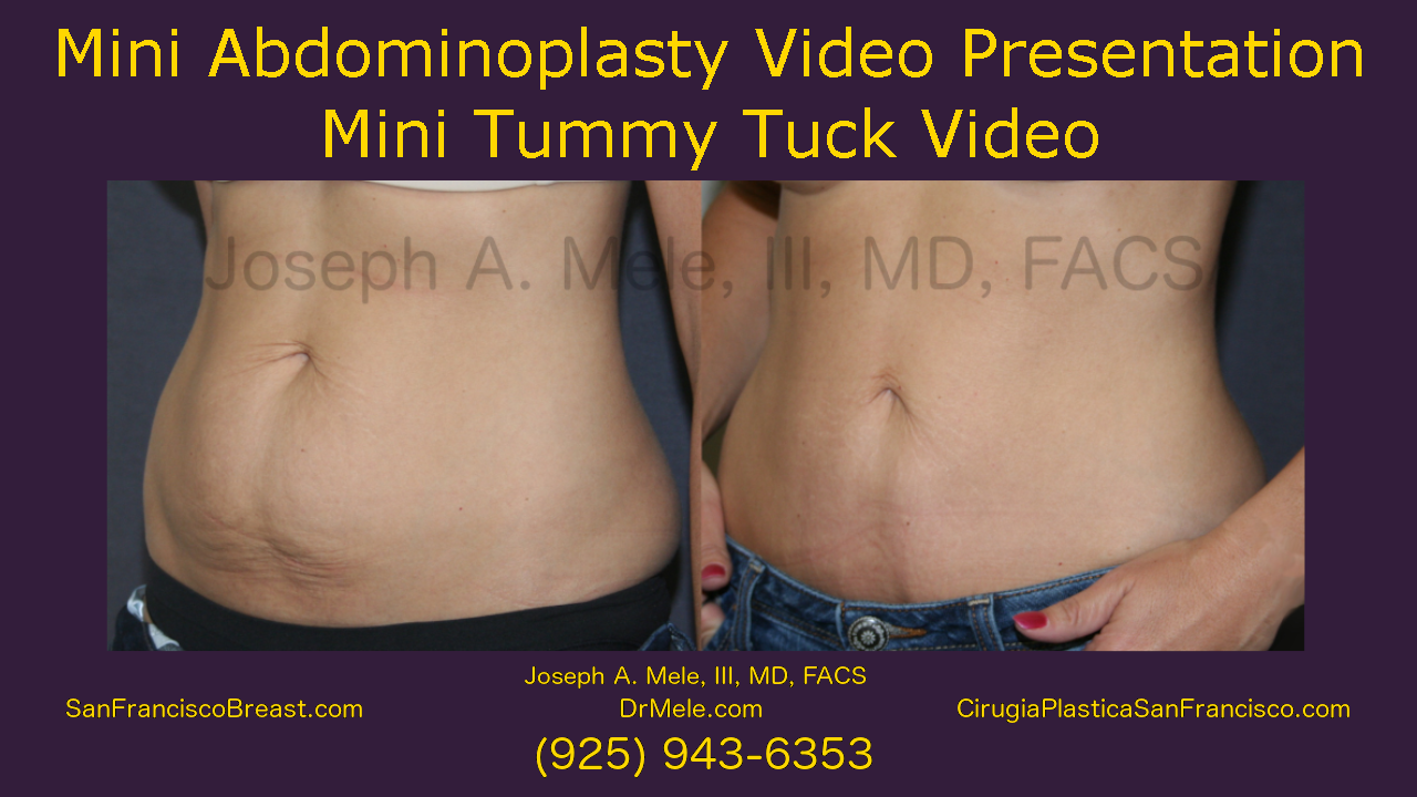Mini Tummy Tuck Video with Mini Abdominoplasty Before and After Pictures