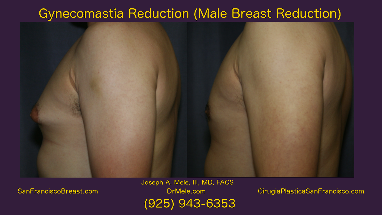 Gynecomastia Reduction Before and After Pictures Video (Male Breast Reduction)