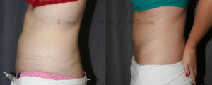 From flabby to fit. A Mini Abdominoplasty was all that was needed to restore this belly.