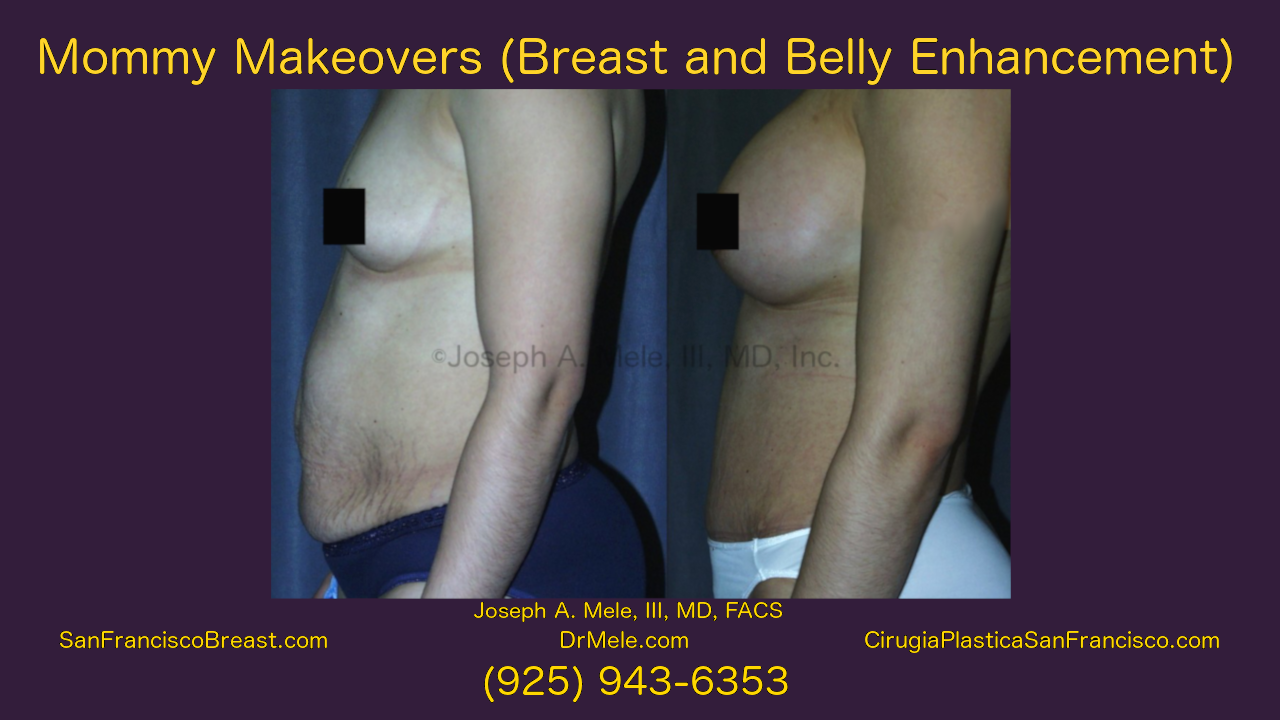 Mommy Makeover Video Presentation with Breast Augmentation and Tummy Tuck before and after pictures