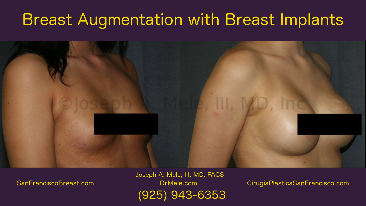 Breast Enlargement with Breast Implants Video Presentation with Before and After Pictures
