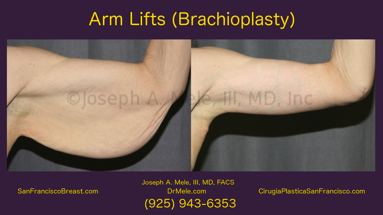 Arm Lift Video Presentation with Brachioplasty Before and After Pictures