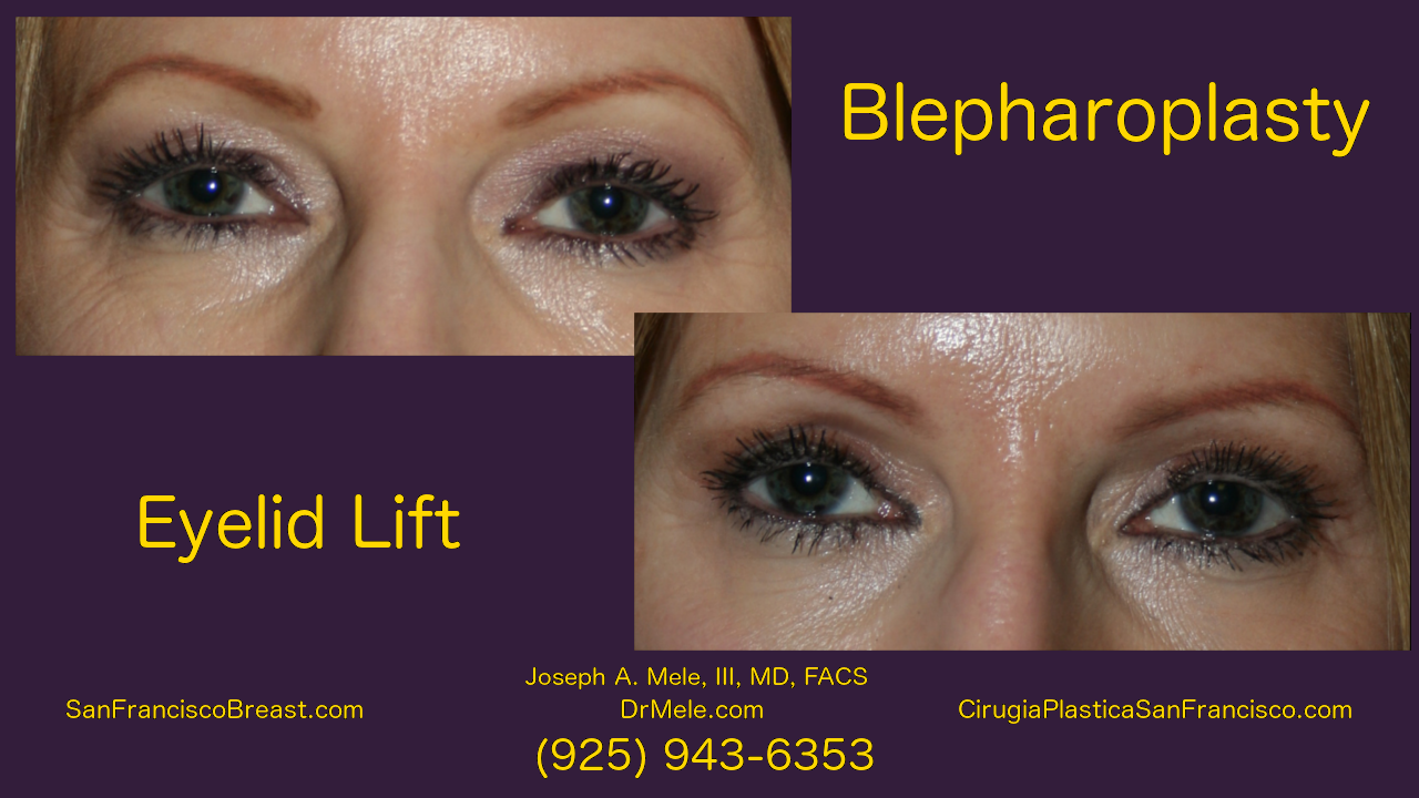 Blepharoplasty Video and Eyelid Lift before and after pictures
