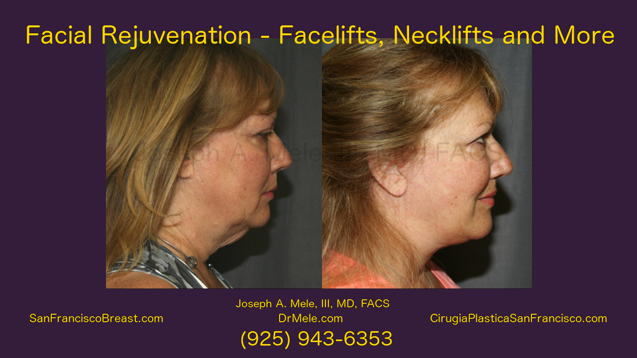 Facelift Video presentation with rhytidectomy before and after images