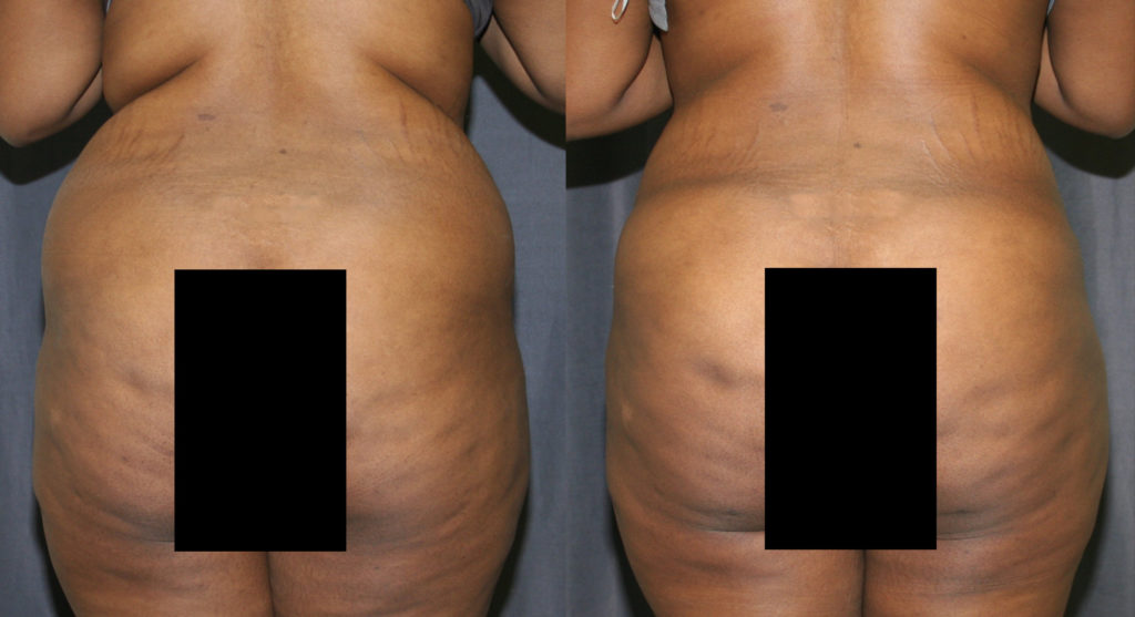 Liposculpture was used to contour and remove excess fat above and below the buttocks. The fat was then grafted into the buttocks to provide additional fullness.