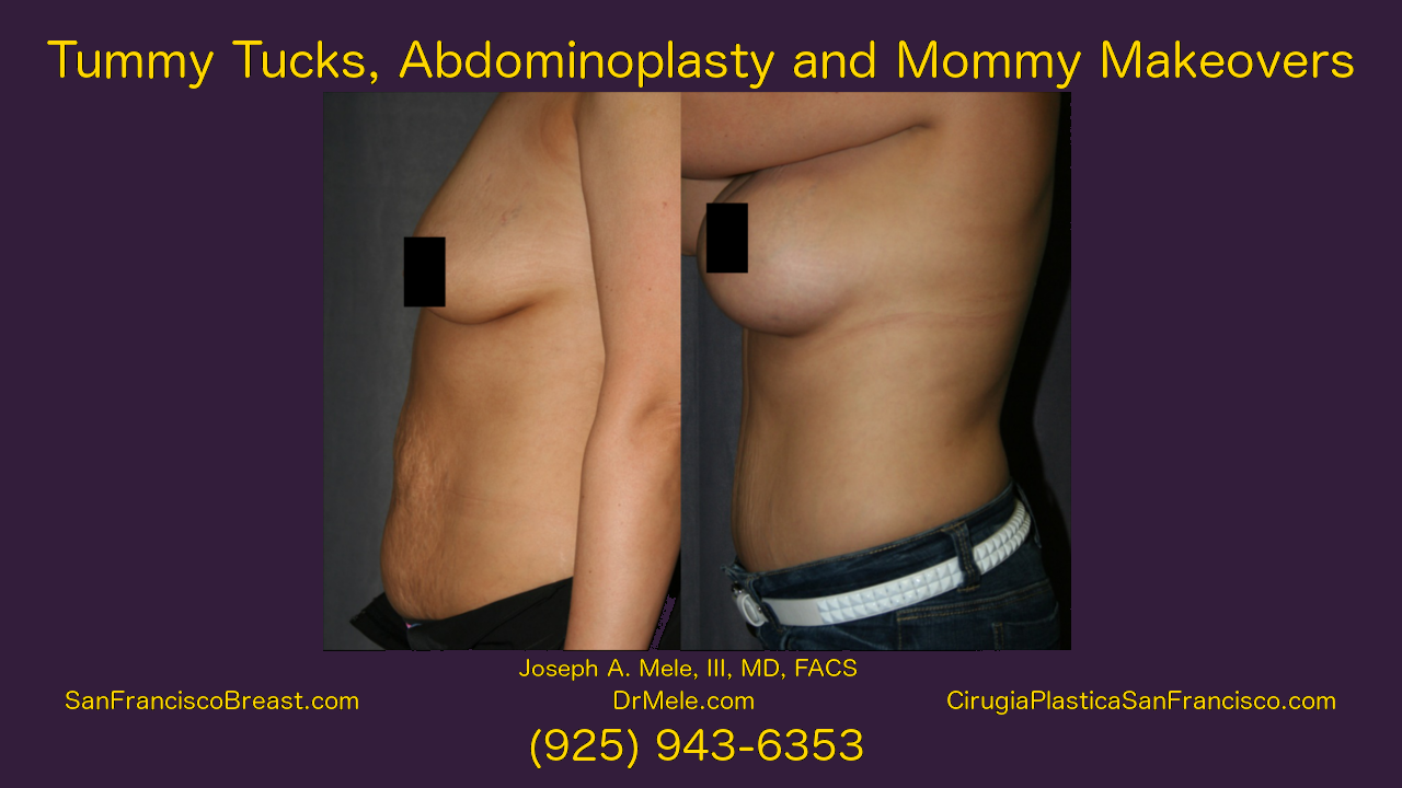 Abdominoplasty Video with Tummy Tuck before and after photos