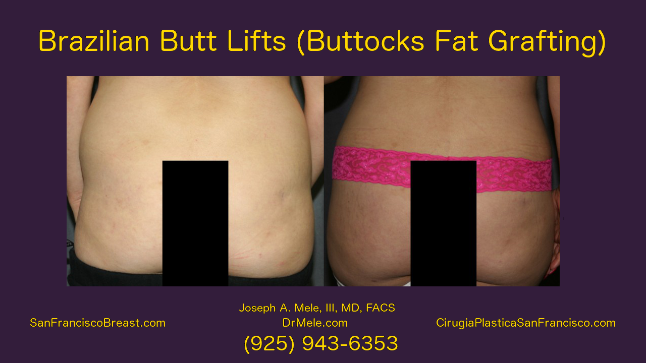 Brazilian Buttocks Lift with buttocks fat grafting before and after pictures