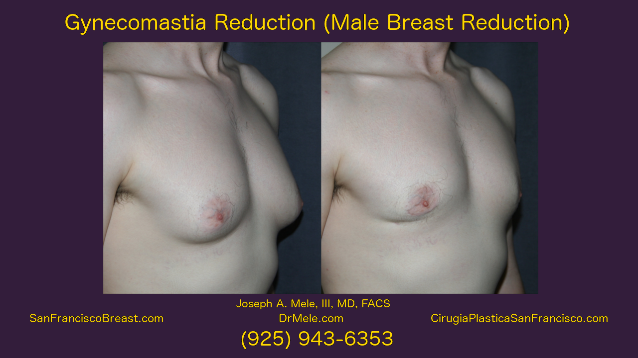 Gynecomastia and Male Breast Reduction Video with before and after photos