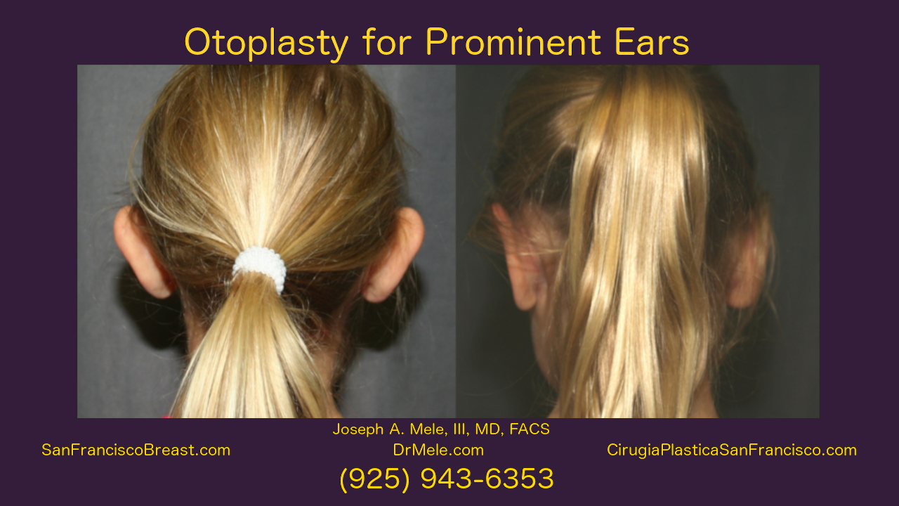 Otoplasty Video with ear pinning before and after pictures