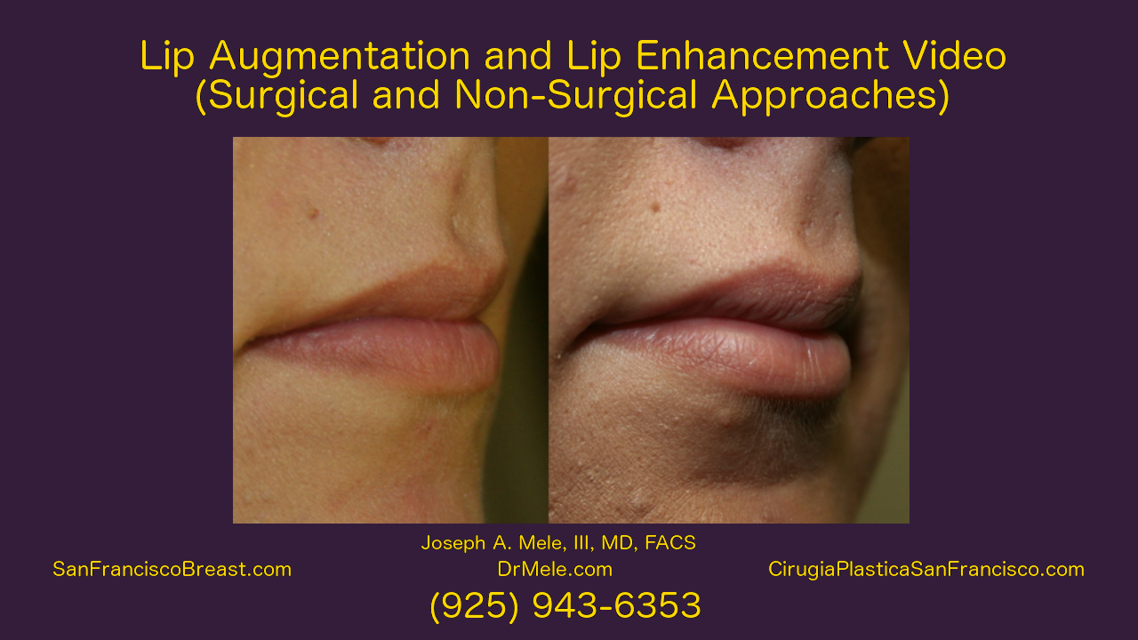 Lip Augmentation Video with lip enhancement before and after pictures