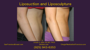 Liposuction Video with before and after pictures