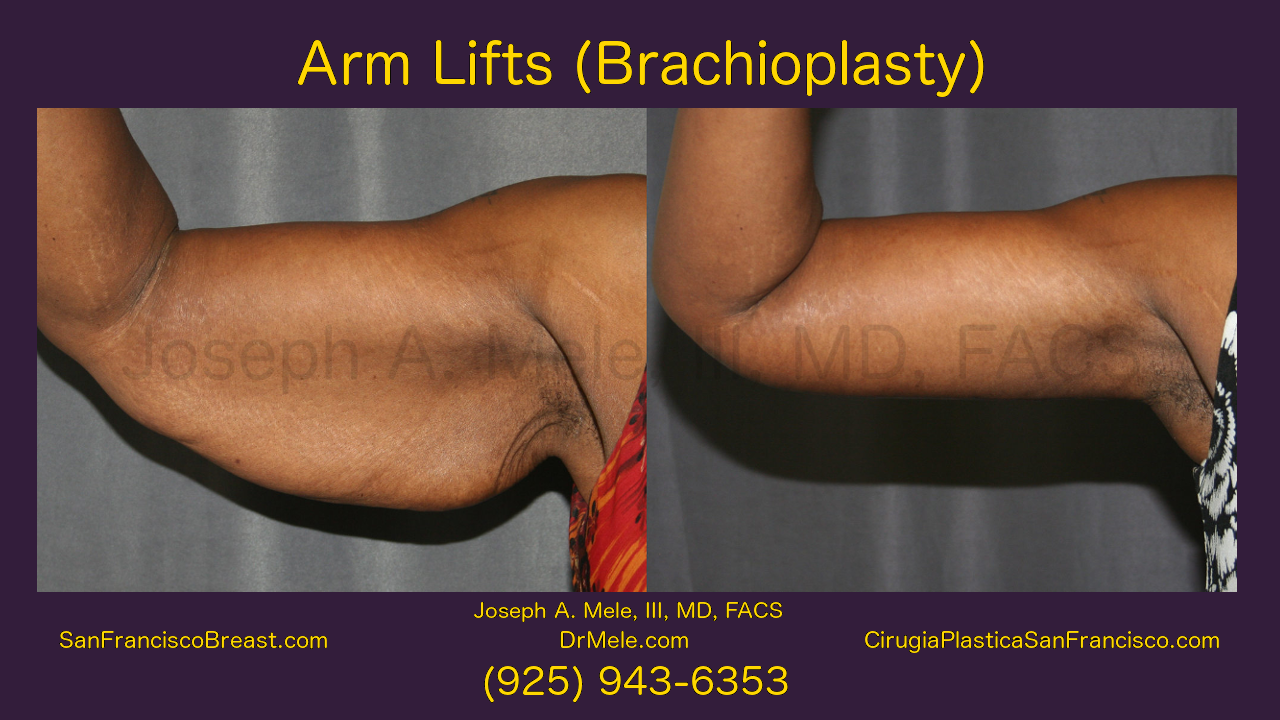 Arm Lift Video with Brachioplasty before and after pictures