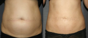 Liposuction of the abdomen can be extended around the sides and back to remove the love handles and muffin top.
