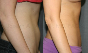 Sometimes Liposuction is just what the doctor ordered for flattening that stubborn belly fat. This liposuction before and after photos shows off the flatter belly that she has worked hard for.
