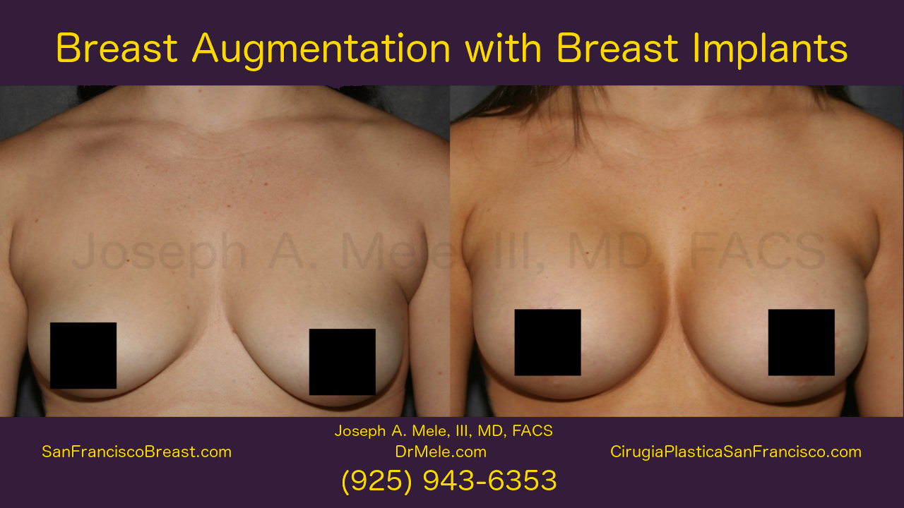 Breast Implants and Breast Augmentation Video with before and after pictures