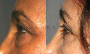 The most frequently used approach to rejuvenating the lower eyelid is the, external, subciliary approach. Not only can it remove excess fat like the transconjunctival approach, but it can also tighten the loose skin while lifting and supporting the lower eyelids.