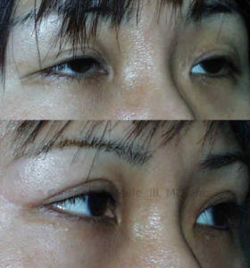 Asian eyelid surgery often includes the formation of a more distinct eyelid crease called the palpebral fold.