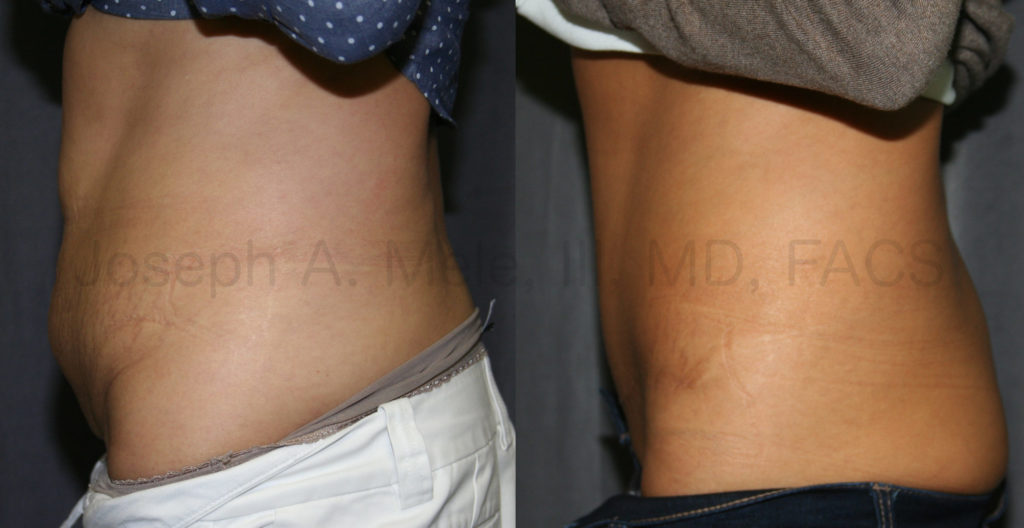 Abdominoplasty is a cosmetic plastic surgery procedure and should only be performed by an experienced, expert, Board Certified Plastic Surgeon.