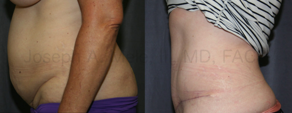 Abdominoplasty tightens the lower abdomen and may also improve stress urinary incontinence.