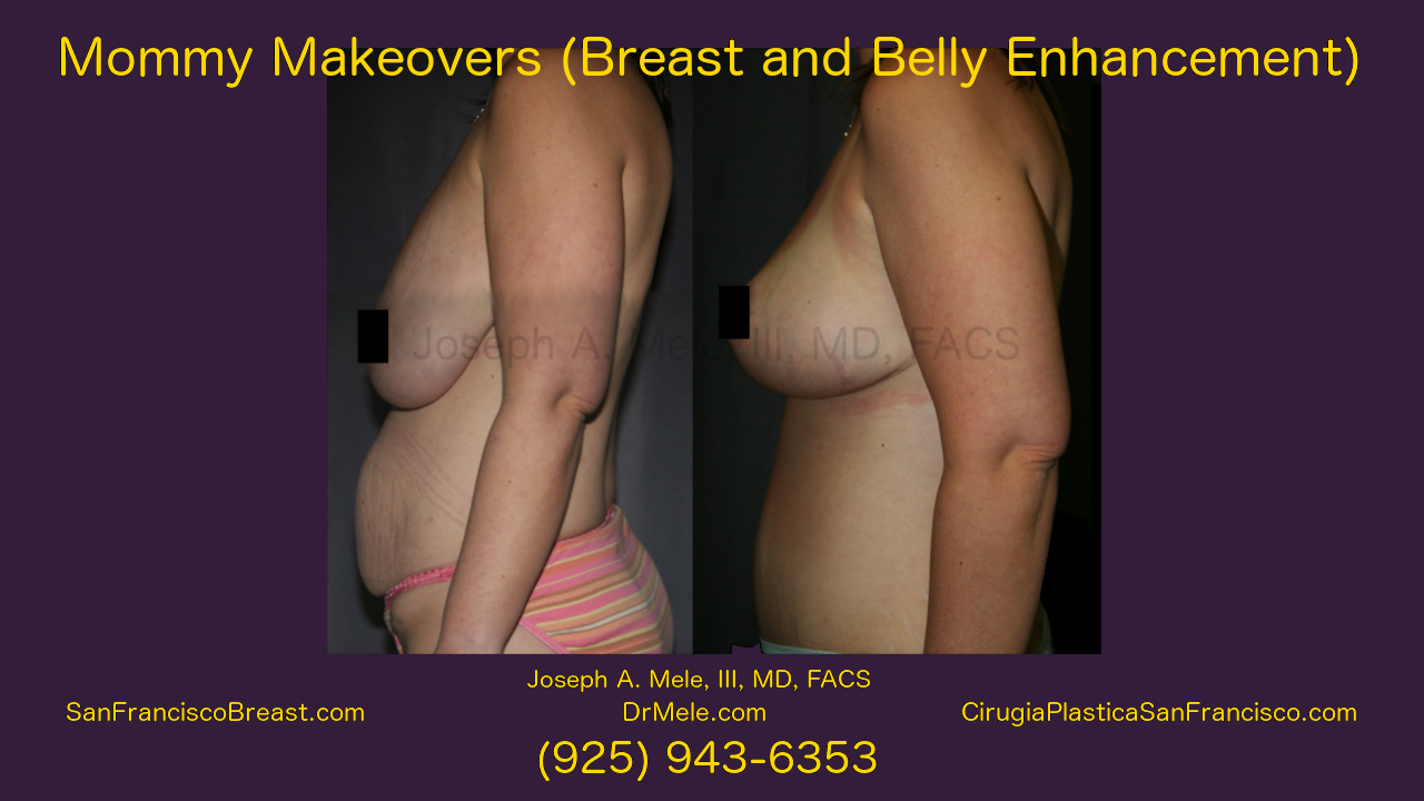 Mommy Makeover Video with breast augmentation and tummy tuck before and after pictures