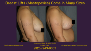 Breast Lift Video with Mastopexy before and after pictures