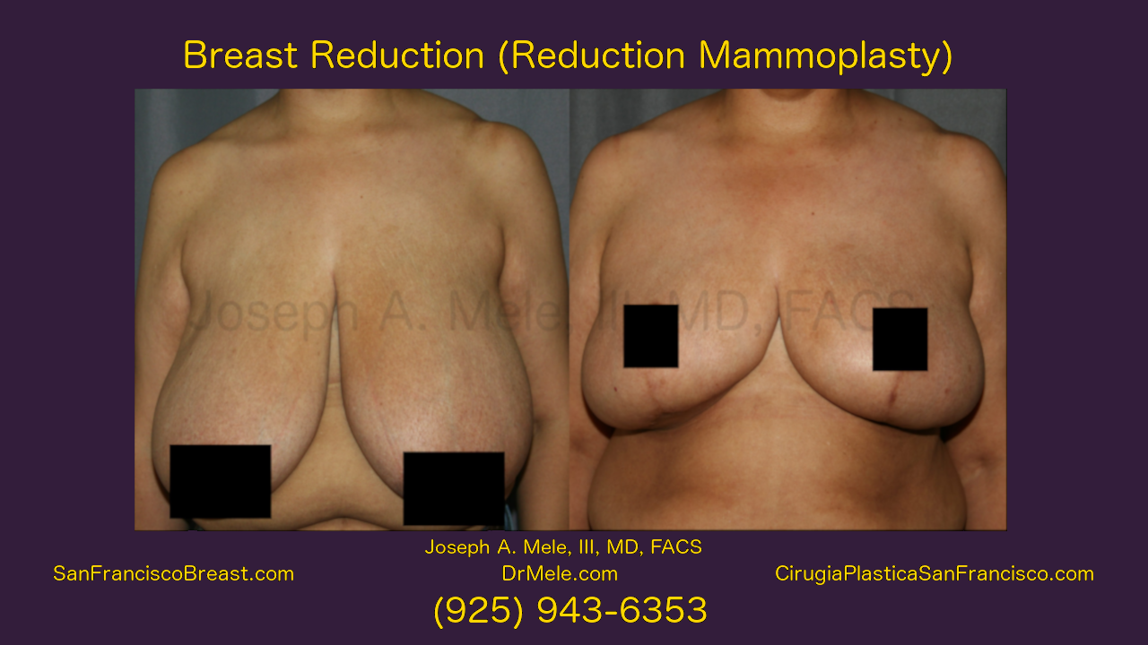 Breast Reduction Video with Reduction Mammoplasty before and after pictures (Female)